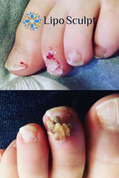 Wart removal customer results from Lipo Sculpt Manchester
